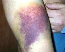 Hematoma